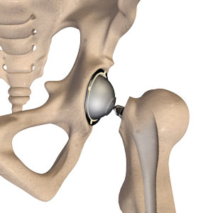 Hip Replacement Surgery - Pontchartrain Orthopedics