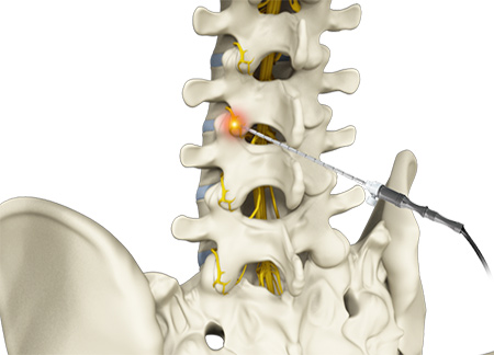 Radiofrequency Ablation