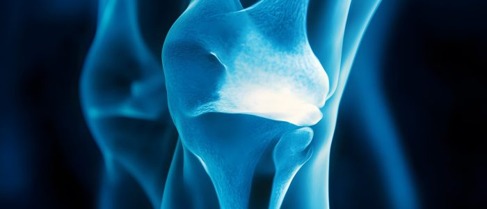 47. A human knee X-ray showing meniscus tears